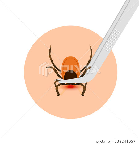 Removing encephalitis ticks after bite. How to remove mite. Parasite carrying disease. Removing encephalitis ticks after bite. How to remove mite. Parasite carrying disease. 138241957