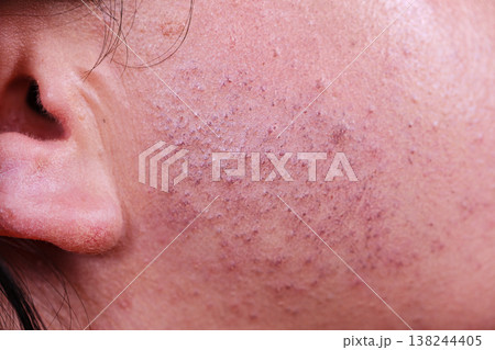 Skin face after removing hair Skin face after removing hair 138244405