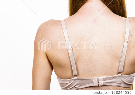 Woman with skin problem acne on back Woman with skin problem acne on back 138244556