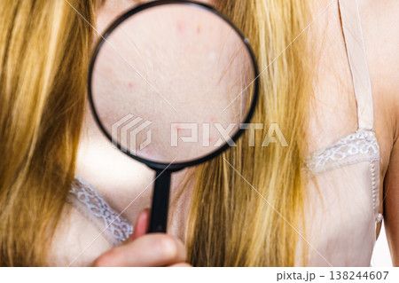 Woman with skin problem acne on neckline 138244607