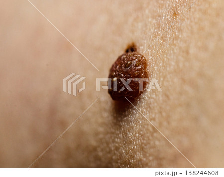 Closeup brown mole on skin. Closeup brown mole on skin. 138244608