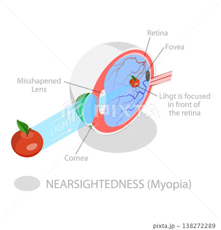 3D Isometric Flat Vector Illustration of Vision Disorder, Far-Sightedness And Near-Sightedness Anatomical Diagram. Item 1 138272289
