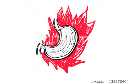 Gastroesophageal reflux pain Gastroesophageal reflux pain 138278404