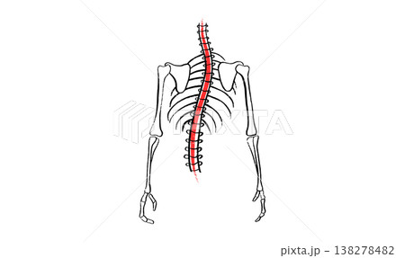 Scoliosis spine deformity Scoliosis spine deformity 138278482