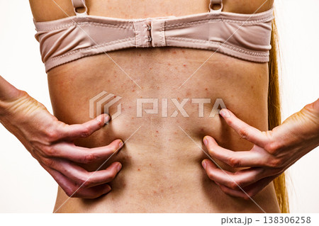 Woman with skin problem acne on back 138306258