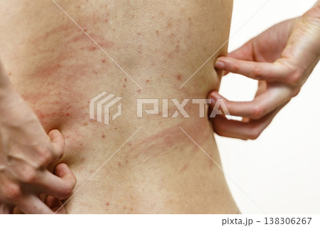 Woman scratching her itchy back with allergy rash 138306267