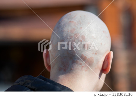 Back view of bald man with psoriasis on scalp. Skin rash and inflammation on head. Medical condition, autoimmune disease, dermatology and health problem concept for patients. Back view of bald man with psoriasis on scalp. Skin rash and inflammation on head. Medical condition, autoimmune disease, dermatology and health problem concept for patients. 138308130