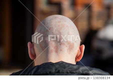 Man with psoriasis on the back of his scalp. Skin disease inflammation and dry red patch on head. Dermatological condition and health issue. Diagnosis of chronic autoimmune disorder. 138308134