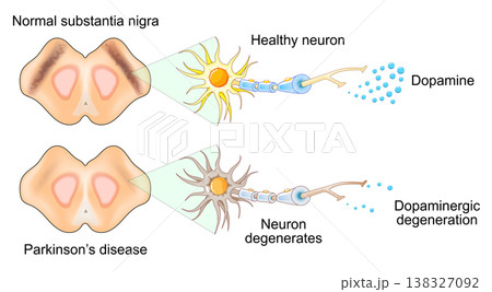 Parkinsons disease. Substantia nigra, Neuron degeneration and Dopamine level Parkinsons disease. Substantia nigra, Neuron degeneration and Dopamine level 138327092