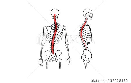 Scoliosis spine deformity Scoliosis spine deformity 138328173
