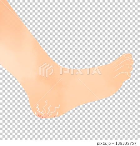 Illustration of cracked heels, watercolor style, representing dryness, rough skin, and skin problems. Illustration of cracked heels, watercolor style, representing dryness, rough skin, and skin problems. 138335757