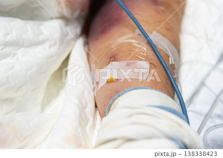 Close up of intravenous catheter inserted in patient arm with medical tape and tubing showing clinical treatment fluid delivery and healthcare monitoring in hospital setting 138338423