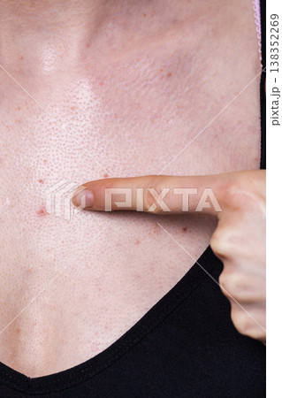 Woman having pimples red spots on chest 138352269