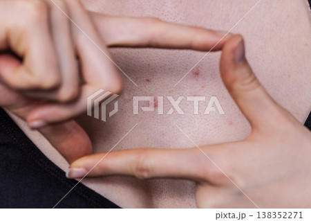 Woman having pimples red spots on chest Woman having pimples red spots on chest 138352271