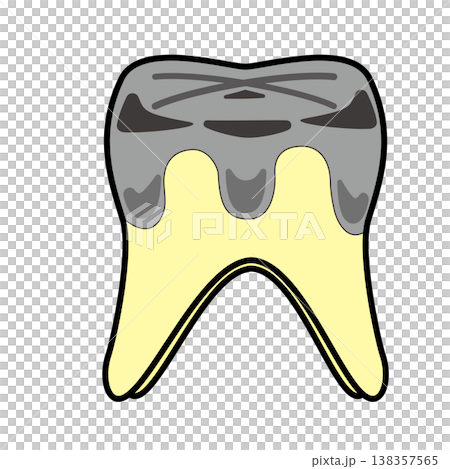 Illustration of a molar with a silver filling and decay / Dentistry and dental care Illustration of a molar with a silver filling and decay / Dentistry and dental care 138357565