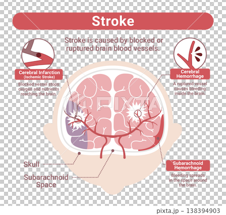 Illustration comparing different types of stroke (cerebral infarction, cerebral hemorrhage, subarachnoid hemorrhage) - English version 138394903