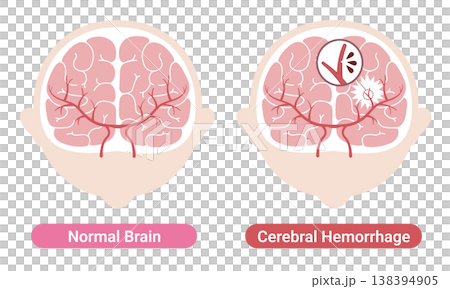 Comparison of a brain with a brain hemorrhage and a normal brain: Medical illustration (English version) 138394905