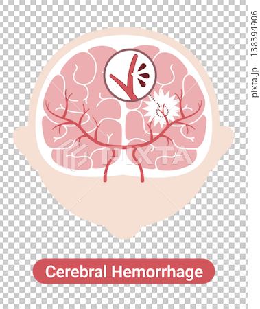 Cerebral hemorrhage: Medical illustrations (English version) 138394906