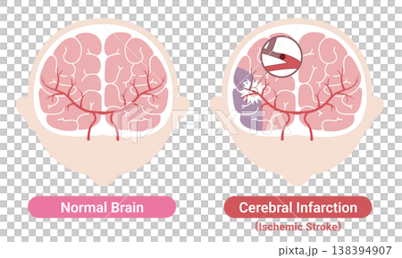Comparison of a stroke-affected brain and a normal brain: Medical illustration (English version) Comparison of a stroke-affected brain and a normal brain: Medical illustration (English version) 138394907