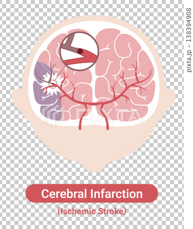 Stroke: Medical Illustrations (English Version) Stroke: Medical Illustrations (English Version) 138394908