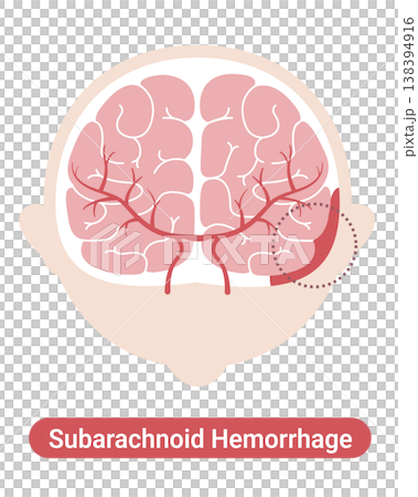 Subarachnoid hemorrhage: Medical illustration (English version) Subarachnoid hemorrhage: Medical illustration (English version) 138394916