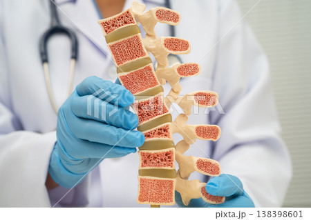 Doctor holding osteoporosis in back bone model. Doctor holding osteoporosis in back bone model. 138398601