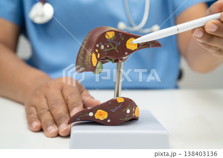 Cirrhosis, Liver cancer, fatty liver, Asian doctor with liver human anatomy model in World Hepatitis Day at hospital. 138403136