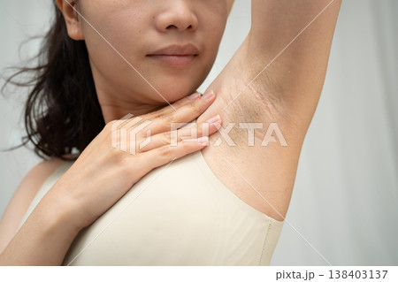 Asian woman have problem black armpit beauty skin care. 138403137