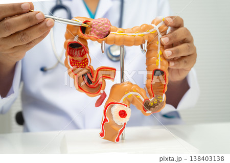 Colorectal cancer, doctor holding intestine colon human anatomy model. 138403138