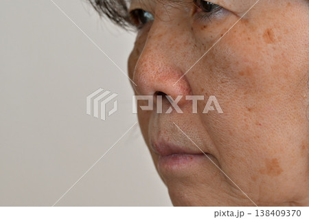 顔のシミ・シワ・ソバカス・ホクロ・イボに悩むシニア女性 顔のシミ・シワ・ソバカス・ホクロ・イボに悩むシニア女性 138409370