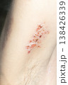 Woman with shingles on the skin she feels very painful 138426339