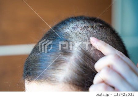 Surgical scar on scalp with hair regrowth after operation. Healing process and recovery after medical procedure concept. 138428033