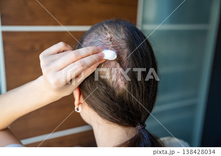 Cleaning surgical scar with sterile gauze pad after applying antiseptic at home. Post surgery wound care and hygiene routine concept. Cleaning surgical scar with sterile gauze pad after applying antiseptic at home. Post surgery wound care and hygiene routine concept. 138428034