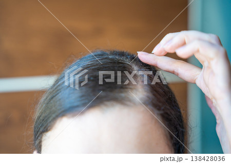Surgical scar on scalp with hair regrowth after operation. Healing process and recovery after medical procedure concept. Surgical scar on scalp with hair regrowth after operation. Healing process and recovery after medical procedure concept. 138428036