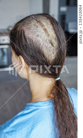 Close up of surgical scar with staples on shaved head after craniotomy for brain tumor removal. Postoperative care, hygiene and recovery process concept. 138428064