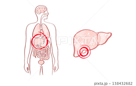 Human Gallbladder Disease Human Gallbladder Disease 138432682