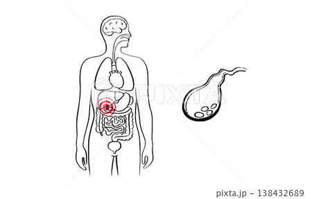 Human Gallbladder Disease 138432689