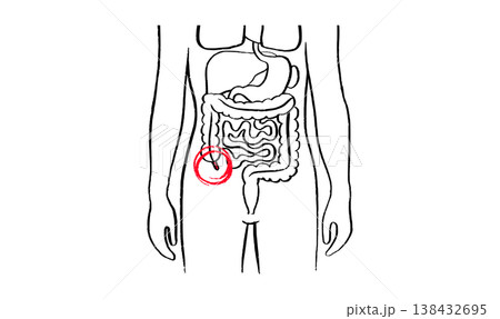 Inflamed appendix scetch 138432695