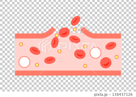 Cross-section of a blood vessel during bleeding 138437126