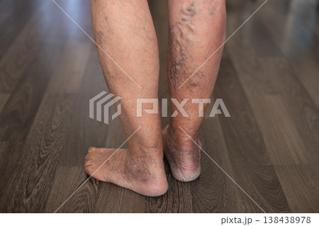 Patient showing severe varicose veins on legs Patient showing severe varicose veins on legs 138438978