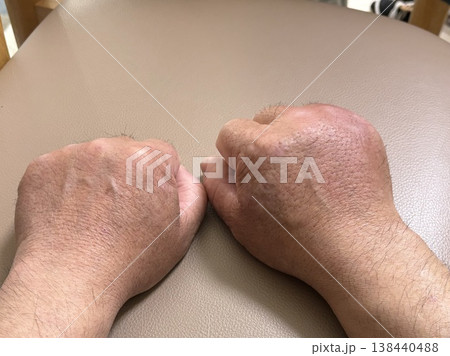 手の腫れ 138440488