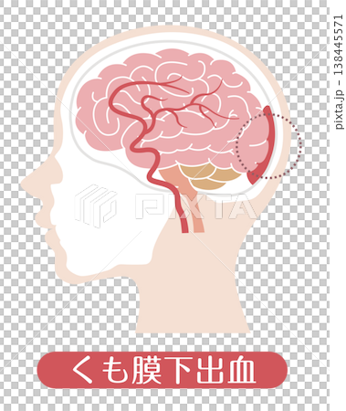 Subarachnoid hemorrhage (medical illustration) Subarachnoid hemorrhage (medical illustration) 138445571