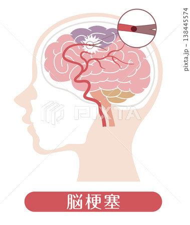 脳梗塞 医療イラスト 脳梗塞 医療イラスト 138445574