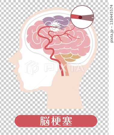 中風（醫學插畫） 138445574