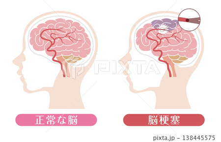 脳梗塞と正常な脳の比較 医療イラスト 脳梗塞と正常な脳の比較 医療イラスト 138445575