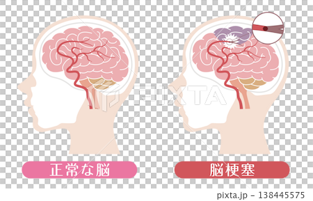 脳梗塞と正常な脳の比較 医療イラスト 脳梗塞と正常な脳の比較 医療イラスト 138445575