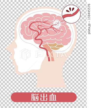 腦出血:醫學插圖 腦出血:醫學插圖 138445576