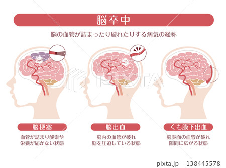 脳卒中の種類（脳梗塞・脳出血・くも膜下出血）解説イラスト 138445578