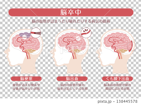 脳卒中の種類（脳梗塞・脳出血・くも膜下出血）解説イラスト 138445578