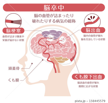 脳卒中の種類比較イラスト（脳梗塞・脳出血・くも膜下出血） 138445579